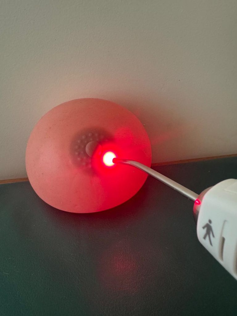 Laser na amamentação para tratamento de fissuras, baixa produção de leite, dor na amamentação. 
