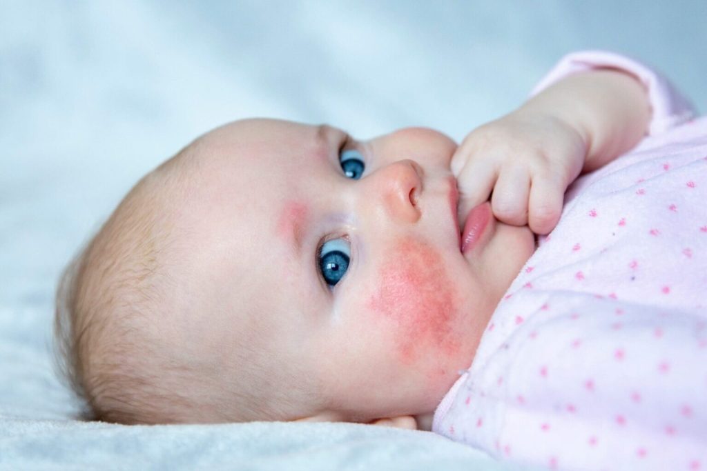 Lesões na pele da dermatite atópica em bebê.