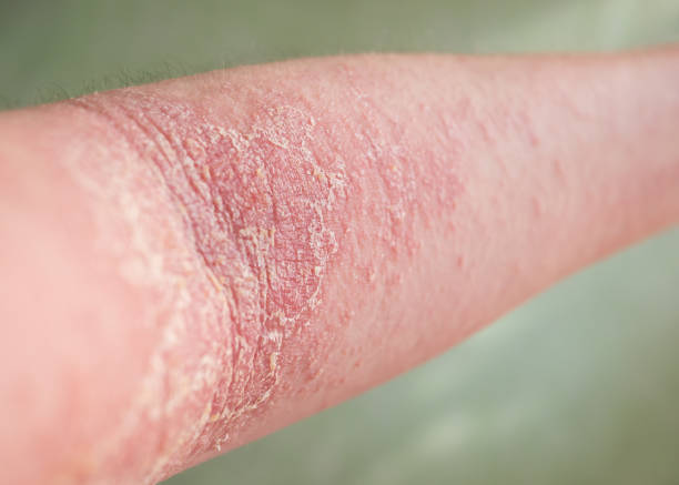Lesão na pele da dermatite atópica.
