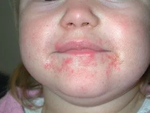 Lesão na pele por dermatite de contato.
